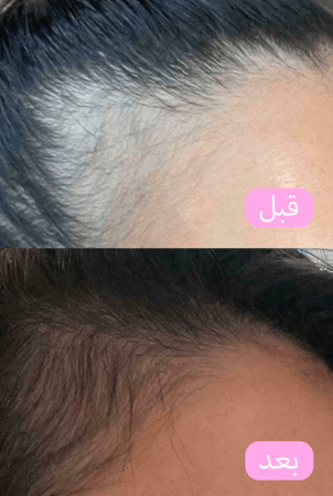 ستارلايت تونيك ماجيك بوست للحد من تساقط الشعر وتعزيز الجذور - 120مل