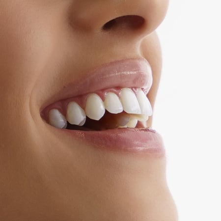 ملمع الأسنان