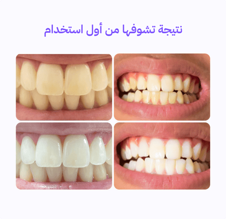 لصقات تبييض الاسنان الأرجوانية