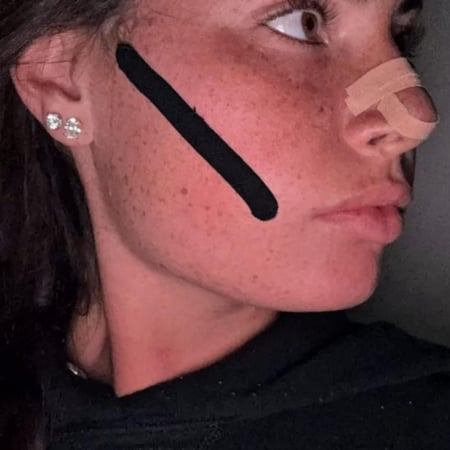 علاج هضبة الانف وتراجع الفك والتنفس الفموي