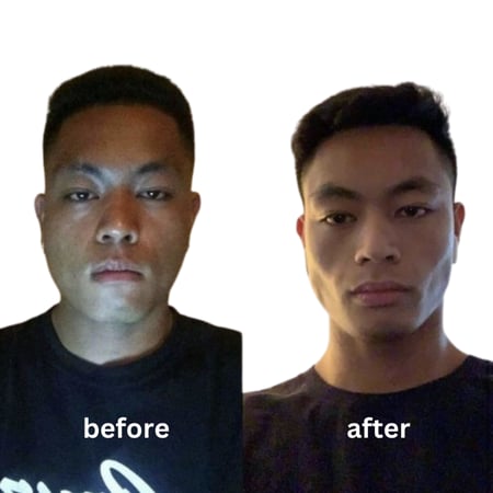 ارشاد طريقة Mewing الصحيحة لعلاج تراجع الفك وهضبة الانف