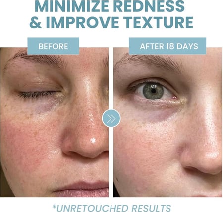 سيروم الوجه بحمض الأزيليك 10بالمية من إيفا ناتشورالز 60 مل