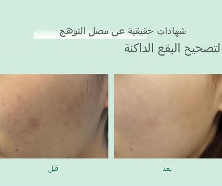 اكسيس واي سيروم توهج لتصحيح البقع الداكنة، 50 مل