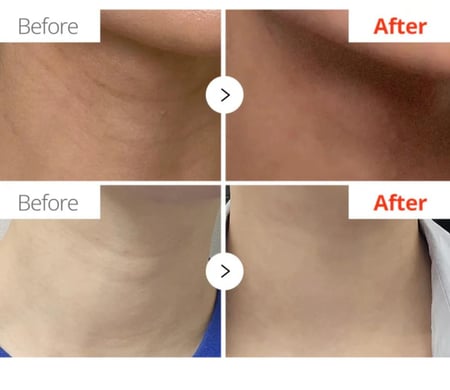 دكتور ميلاكسين كريم العناية بالرقبة نيكسفالت بالسيراميد - 50 جرام