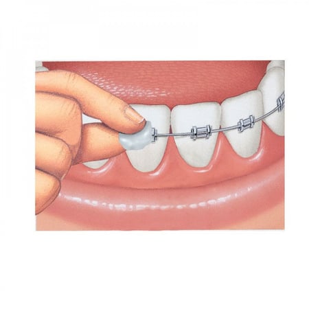 شمع تقويم الاسنان , Gum , بنكهة النعناع