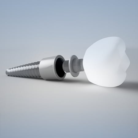 تركيب اسنان