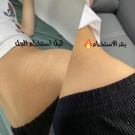 سوفت جل بلس لعلامات التمدد -