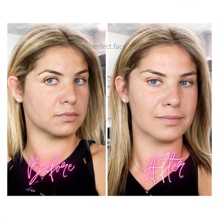 المشبك الخفي لشد الحاجب والوجه - سنقل