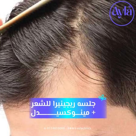 الريجنيرا  بديل زراعة الشعر +منوكسيديل