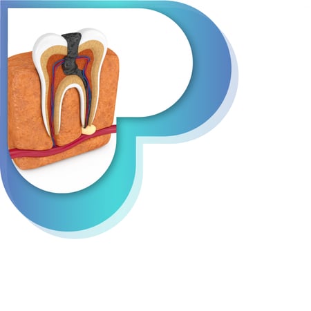 علاج عصب قناة واحدة