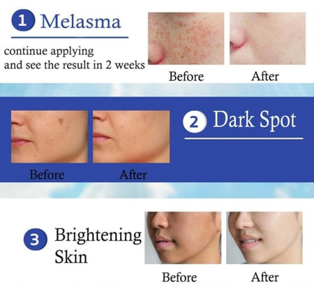 يانهي كريم الكلف Yanhee Mela Cream