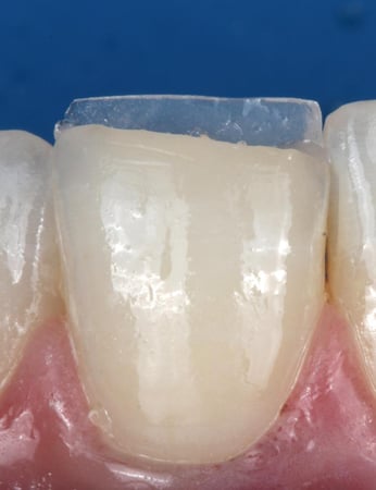 incisal composite flowable (INC)