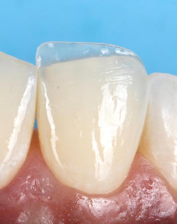 incisal composite flowable (INC)