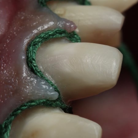 Retraction Cord Applicator