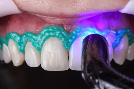 عازل اللثة السائل Top Dam