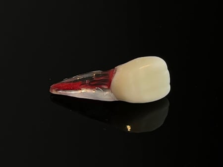 Endo tooth plastic