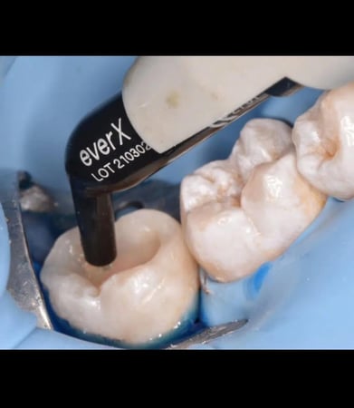 everX posterior per 1 capsule