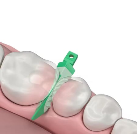 Composite Wedge Kit