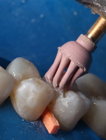 ملمع الحشوات الخلفية Occluflex