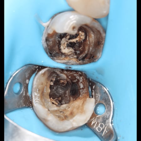 ربر دام الاحترافي rubber dam