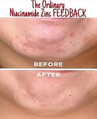 ذا اوردينري محلول نياسيناميد 10٪ زنك 1٪ - 60 مل