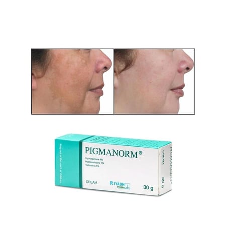 كريم لتفتيح الأماكن الداكنة بالجسم بيجما نورم 30 جم