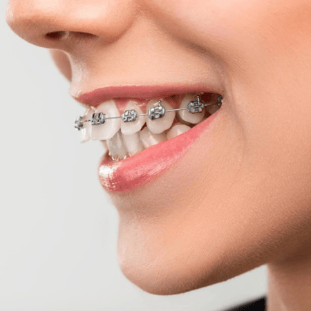 حالة تقويم معقده فك واحد