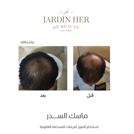ماسك السدر