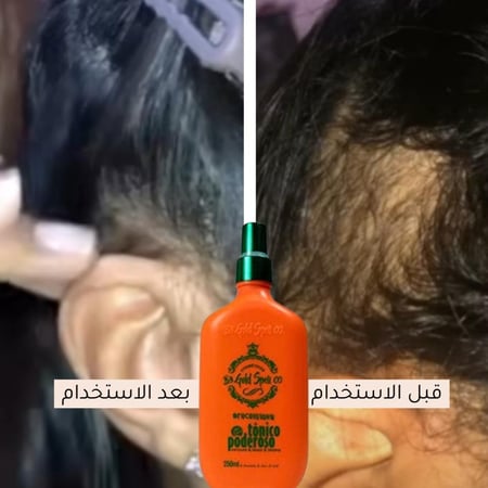 تونيك للشعر – Gold Spell – Tonico Poderoso – تقليل التساقط وتغذية فروة الرأس – 250 مل – Made in Brazil