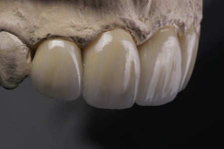 301 . تاج خزف على زركون Zircon crown with porcelain