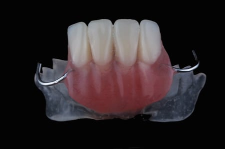 251. طقم جزئي سفلي سن واحد بحد اقصي 5 اسنان  Lower partial denture one tooth to 5