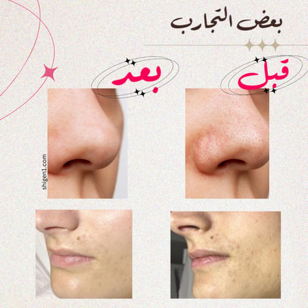 تنظيف البشرة ( الهيدرافيشال )