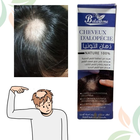 زيت علاج الثعلبة