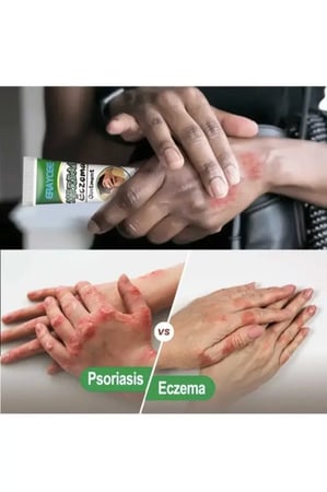 مرهم اكزيما عشبي، مرهم طبي لالتهاب الجلد، والحكة، علاج الصدفية