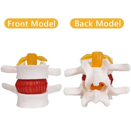 مجسم أمراض الانزلاق الغضروفي الديسك