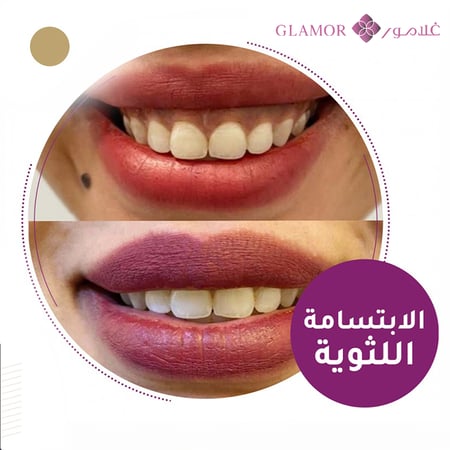الابتسامة اللثوية GUMMY SMILE
