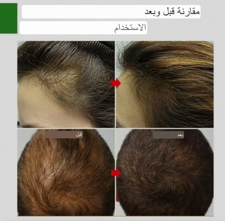 كورس 5 حبات زيت اكليل الجبل  لعلاج مشاكل الشعر