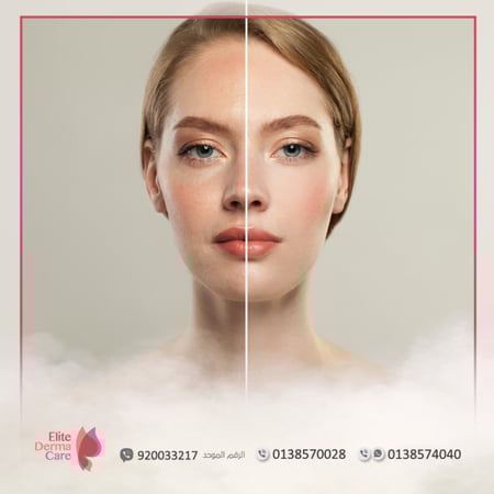 جلسة بشرة زجاجية  بالهيدرافيشال    -  الأطباء الاخرى (للجنسين)