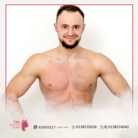 ليزر منطقة الصدر -  متجر عيادات الدكتورة ليلى العنيزي الطبي - الخبر