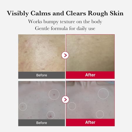 بخاخ ميديكيوب لتقشير الجسم حب الشباب – 110 جم