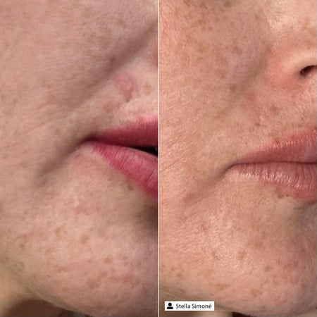 Derma SR Pure Hyaluronic Essence