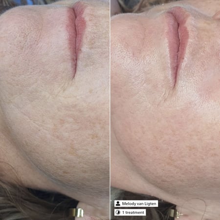 تدريب البشرة الشامل ديرما اس ار