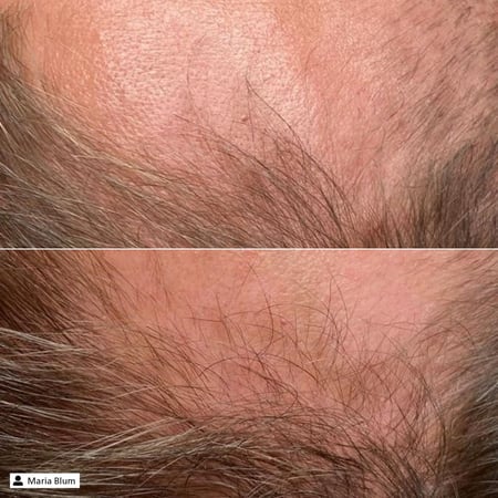 نتائج انبات الشعر