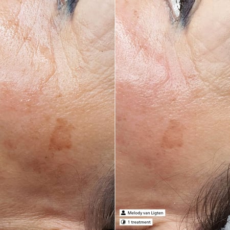 Derma SR Anti-Pigment Serum