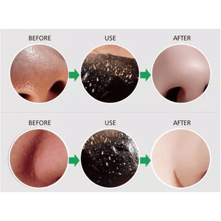 ماسك لإزالة الرؤوس السوداء بالفحم من ليزر وايت - 50مل