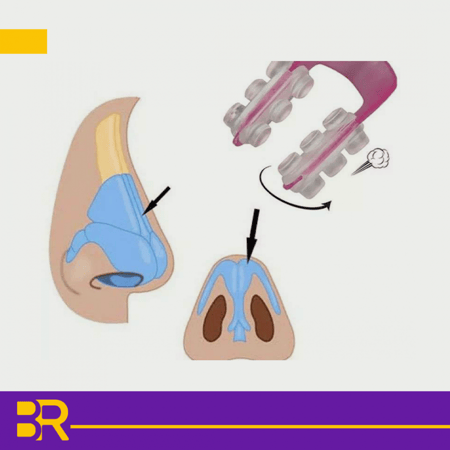مقوم انف وردي