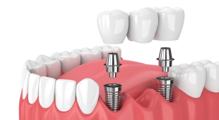 جسور الاسنان تبسم بلس