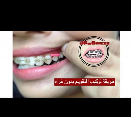 تقويم اسنان زينة (بكج)فكين منفصل بدون غرا " شامل الشحن "