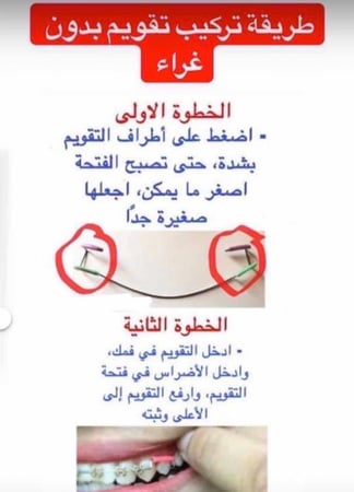 تقويم اسنان زينة (بكج) فك بدون غرا متصل " شامل الشحن "