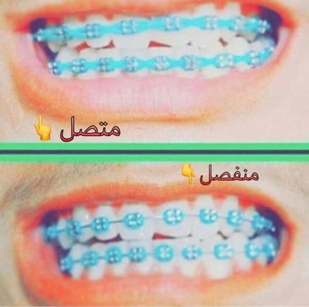 تقويم اسنان زينة (بكج) فك بدون غرا متصل " شامل الشحن "